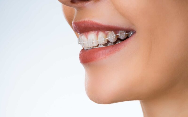 apparecchio dentale per bambini a roma