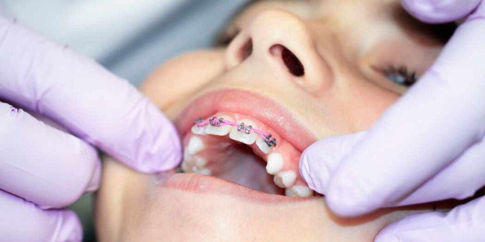 bambina usa apparecchio dentale fisso, apparecchio dentale bracket