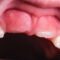 infezione gengivale bambini, irritazione gengive causa dentizione