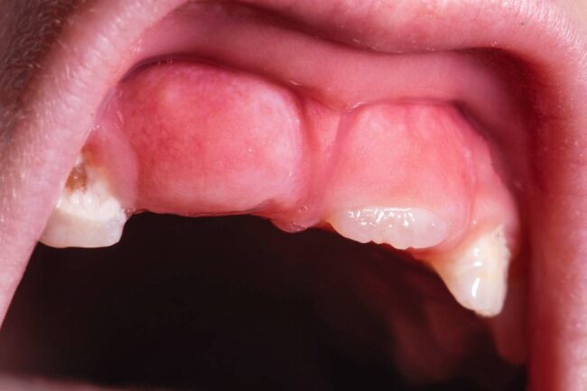 infezione gengivale bambini, irritazione gengive causa dentizione