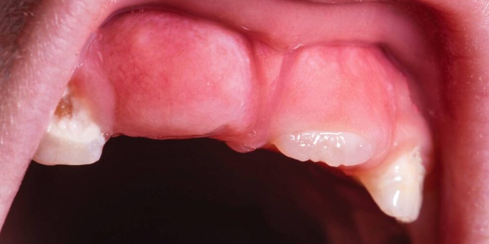 infezione gengivale bambini, irritazione gengive causa dentizione